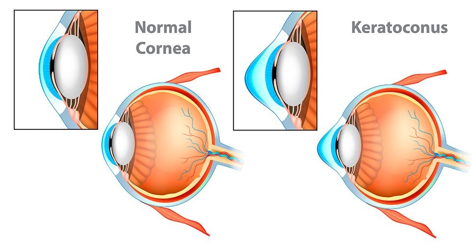 Keratoconus